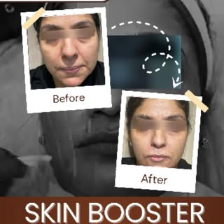 ✨ INSTANT GLOW. ZERO DOWNTIME. GAMECHANGING RESULTS. ✨⁠

 ⁠
 This 1ml injection is your secret weapo