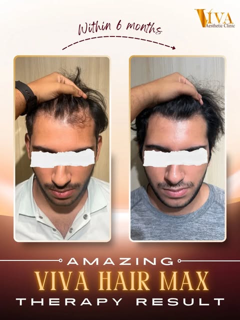 ✨ 6 months of transformation, and the growth says it all. ✨

From visible thinning to a fuller, natu