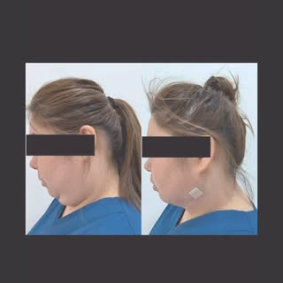 Instant double chin removal with long lasting result . 和双下巴永别是什么滋味？ 🤔💭🤨 #doublechin #doublechinre