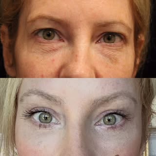 An upper face rejuvenation means tiny tweaks including a #browlift #upperblepharoplasty #lowerblepha