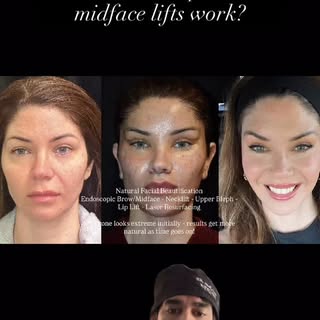 #ponytaillift #foxeyes #cateyes #canthoplasty #canthopexy #deepplanefacelift #facelift #blepharoplas