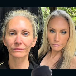 Our beautiful patient is just a few weeks out from a “scarless” endoscopic #deepplanefacelift and lo