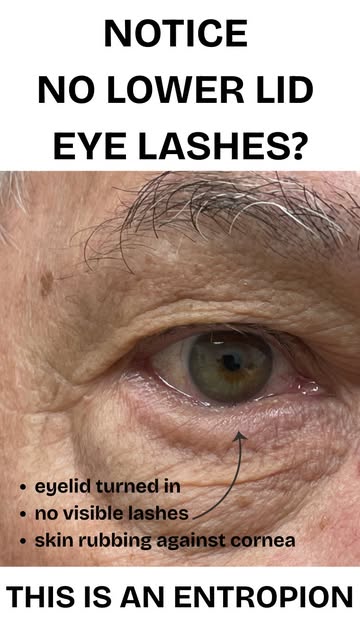 What is entropion? 👁️

When your eyelid turns inward due to laxity, either from age-related weakeni
