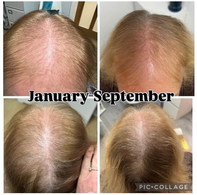 Menopausal Hair Loss.

I think you’ll agree my lovely lady was delighted with the results of her bes