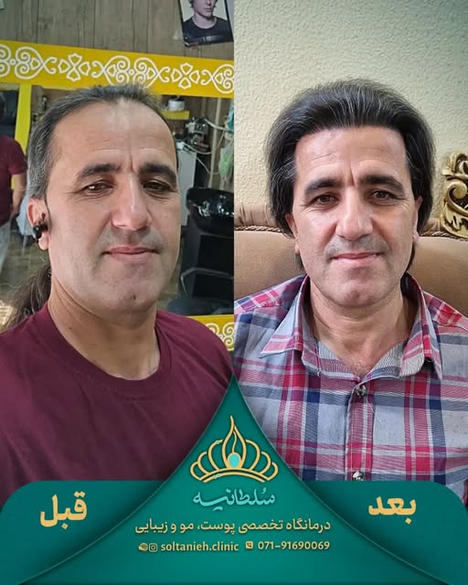 وقتی موها بیشتر می‌شن، چهره هم می‌تونه حال‌وهوای متفاوتی پیدا کنه. ✨
در این نمونه‌کار، تفاوت تراکم م