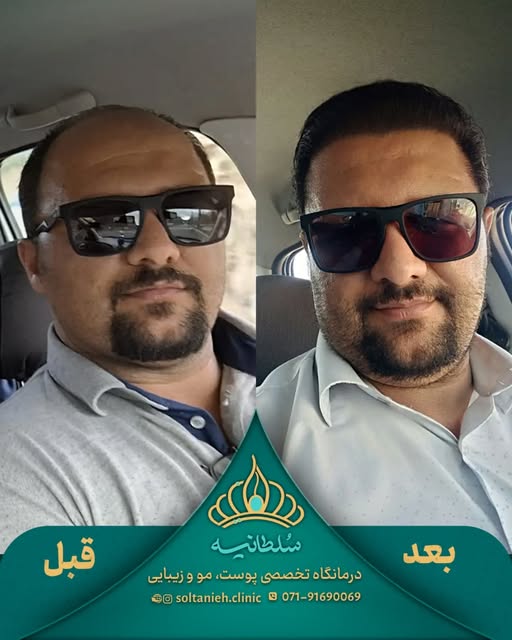 موها فقط بخشی از ظاهر ما نیستن؛ روی فرم و حال‌وهوای چهره هم تأثیر دارن. ✨
در این نمونه‌کار کاشت مو، 