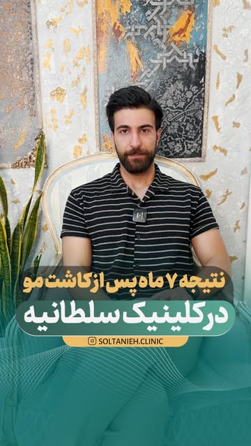 یک نتیجه کاشت مو بسیار محسوس و پر تراکم در کلینیک سلطانیه شیراز همراه با خط رویش کاملا طبیعی و کاشت 