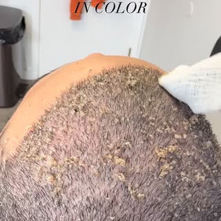 Hey Hair Fam! 💁🏽‍♀️ This video is sped up ⏩ but this is what scab removal looks like around 10 day