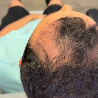 PRP isn’t just an add-on — it’s one of my favorite ways to support healthier, stronger hair growth b