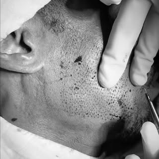 From bare to beard . 👌🏾

A beard transplant uses your own hair to permanently fill in patchy spots