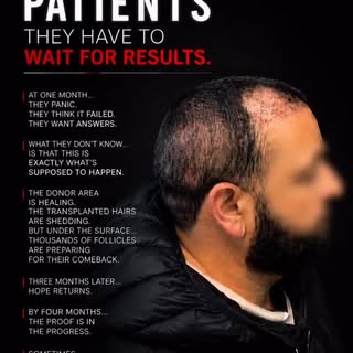 🎬 Netflix presents: Me reassuring patients to trust the process. ❤️

Every hair transplant has a st