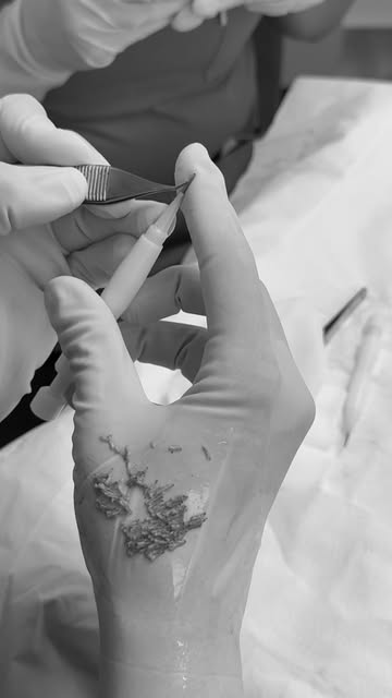 ✨ DHI Hair Transplant — made for precision.

DHI is perfect for filling in thinning areas and adding