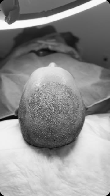 Hair transplants can restore hair volume/thickness. You don’t have to be completely bald to get a ha