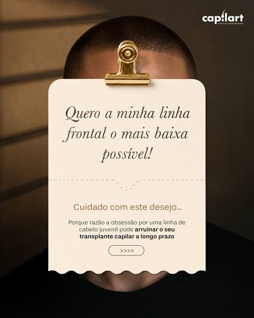 Num transplante capilar, baixar a linha frontal ao máximo não significa conseguir um resultado melho