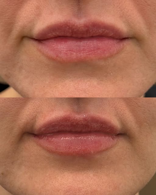The goal was never bigger. It was hydration, symmetry, and a soft border that still looks like her. 