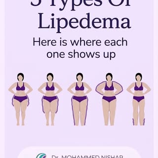 Understanding Your Lipedema Type

While we know Lipedema looks different on everyone, it is formally