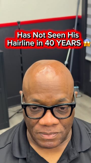 40 YEARS. 😳

He hadn’t seen a hairline like this on himself in 40 years.

Today, we changed that. �