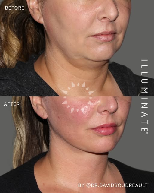 A refined jawline and smoother neck that looks natural, not overdone ✨

Dr. B's (@dr.davidboudreault