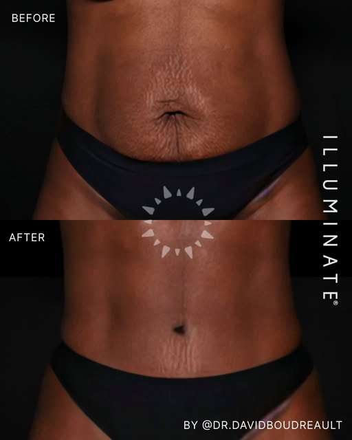 A complete transformation, one recovery 🌟 

Tummy tuck and liposuction combined strategically so th