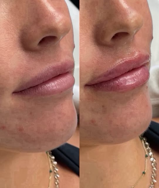 A little lip refresh!

Lip filler isn’t about changing your lips — it’s about enhancing your natural