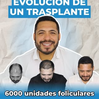 ¡UNA GRAN EVOLUCIÓN! Este es el proceso de un TRASPLANTE CAPILAR DE IMPACTO🤩🌟. Solo así lograrás e