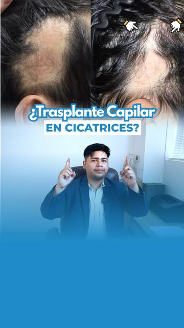 ¿Trasplante Capilar en cicatrices? 👀 /// Mira este caso!! ✨ No dudes en separar tu cita a nuestro W