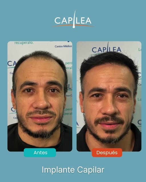 El resultado que buscaba, diseñado para él. 😎💯

Nuestro paciente presentaba pérdida de densidad en