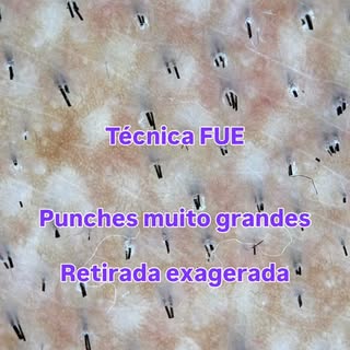 #transplantecapilar #calvície #tecnicafue