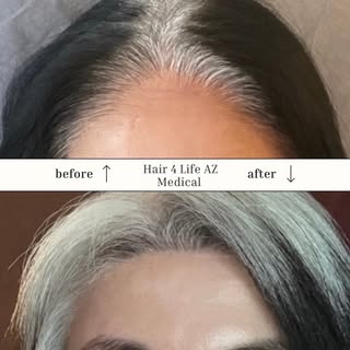 ✨ From visible scalp to beautifully restored density! ✨

This before-and-after is a great example of