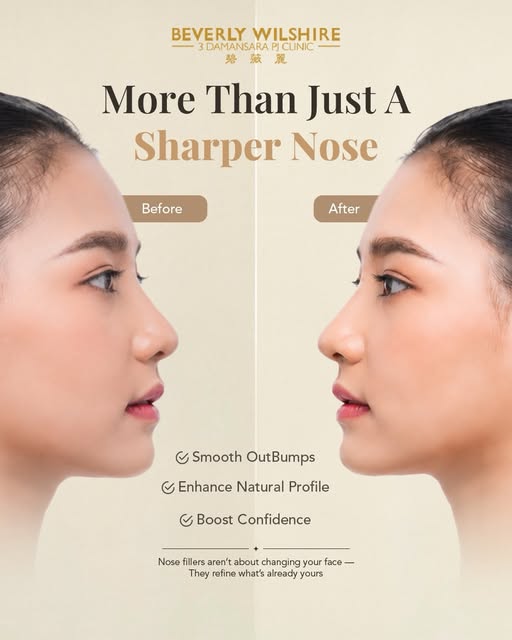 Subtle changes. Balanced beauty. ✨

Nose fillers are designed to enhance harmony — not completely ch