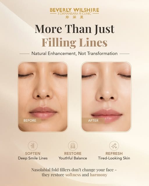 ✨ Nasolabial fold fillers are not about changing your features — they’re about restoring balance, su
