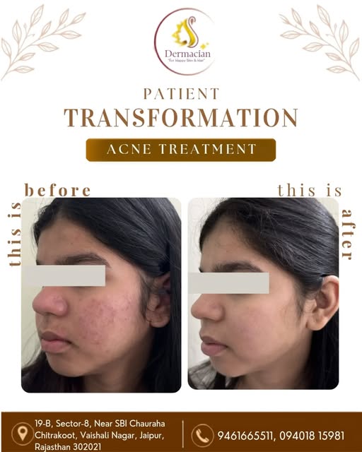 ✨ Real skin. Real progress.

Acne can affect more than just your skin — but with the right diagnosis
