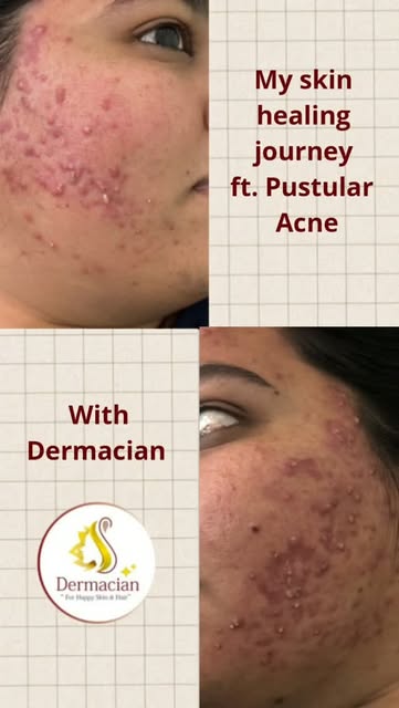My skin healing journey with Dermacian. ✨**

Pustular acne can be persistent and frustrating, but wi