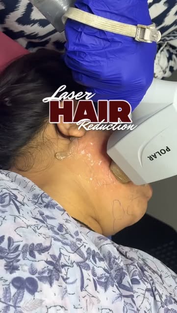 Tired of constantly shaving, waxing, or threading? ✨

Laser Hair Reduction can help reduce unwanted 