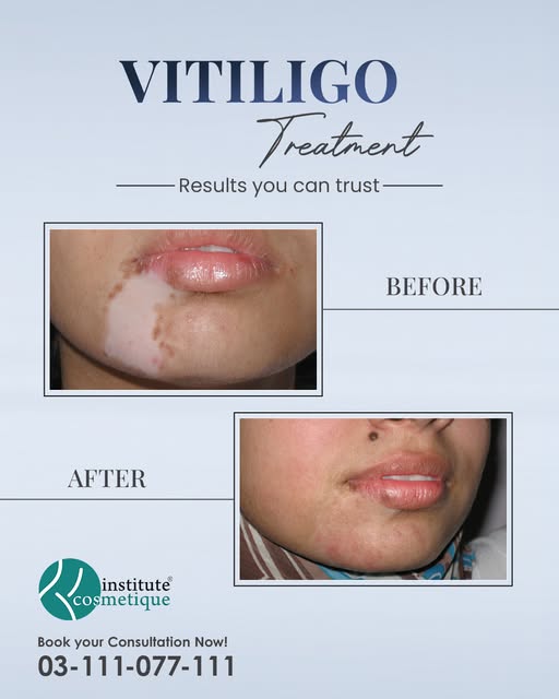 Vitiligo can be managed with the right treatment and expert care.
Explore personalized vitiligo trea