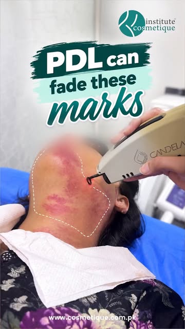 That red mark won’t fade on its own. At Institute Cosmetique, expert dermatologists fade it with adv