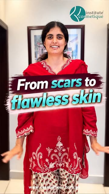 Struggling with melasma, acne scars & patches? Watch her journey to flawless skin with Prof. Dr. Azi