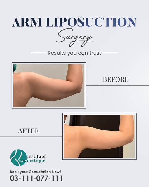 Tired of stubborn arm fat? These are real results from real patients! Smoother, more contoured arms 