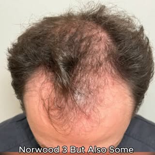 Norwood 3 in the front with thinning starting in the crown.

For this 37-year-old patient, our goal 