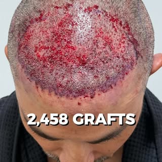 2,458 grafts later, the hairline has been rebuilt with careful attention to natural anatomy, graft d