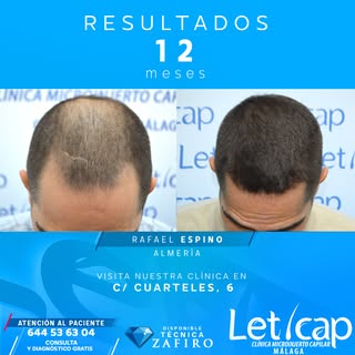 📸 Rafael Espino, paciente de Leticap, alcanza con éxito un resultado espectacular tan sólo 12 meses