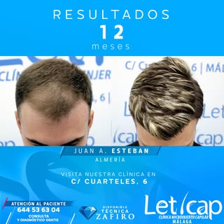 Hace un año, Juan Antonio Esteban decidió dar un paso importante para tratar su alopecia: confiar en