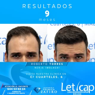 Roberto Torres volvió a visitarnos a los 9 meses de su intervención de microinjerto capilar en Letic