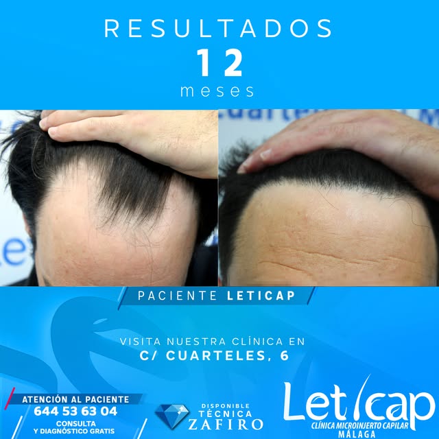 ¿Y si recuperar tu pelo fuera el principio de todo? 👇

En Leticap lo tenemos claro: un injerto capi