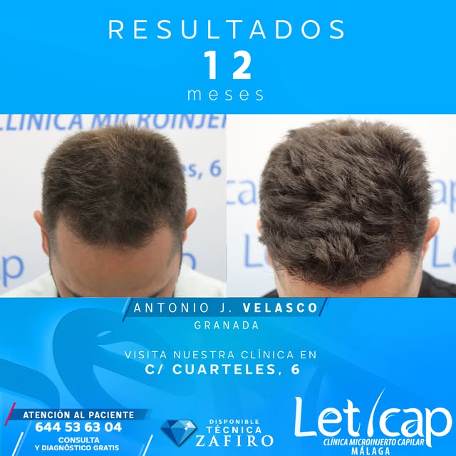 En Leticap sabemos que dar el paso hacia el injerto capilar es mucho más que un cambio físico: es re