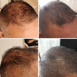 💥 Thin hair? Visible gaps? We've got you covered.

These before & after results show how Scalp Micr