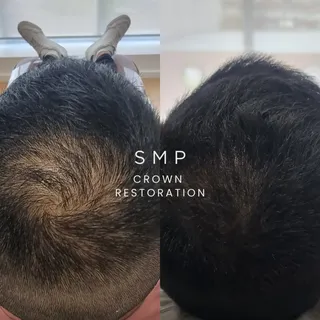 SMP Crown Restoration ✨

A noticeable difference with a natural-looking finish.

This before & after