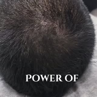 The power of SMP 💥

From a thinning crown to the look of fuller hair.

Scalp Micropigmentation crea