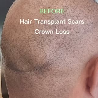 This is where SMP can make a huge difference. ✨

Years after his hair transplant, our client still p