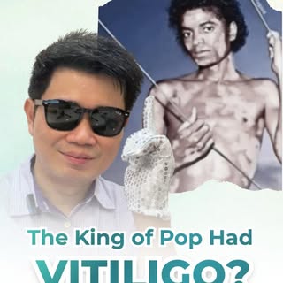 When people hear “vitiligo,” many immediately think of Michael Jackson.Many people thought Michael J